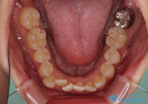 前歯のデコボコをインビザラインでスッキリと仕上げるの治療前