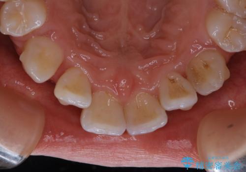 20代女性 インビザラインでのマウスピース矯正中にPMTCできれいな口元にの治療前