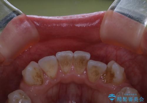 20代女性 インビザラインでのマウスピース矯正中にPMTCできれいな口元にの治療前