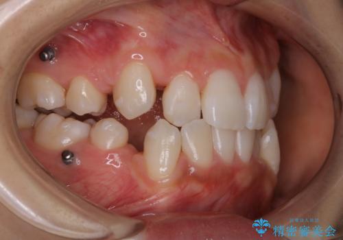 20代女性 インビザラインでのマウスピース矯正中にPMTCできれいな口元にの治療後