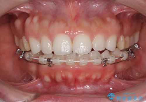 目立たない装置で横顔のシルエットを改善 ハーフリンガルでの抜歯矯正の治療中