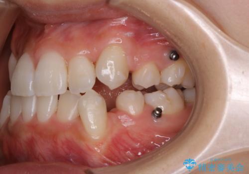 20代女性 インビザラインでのマウスピース矯正中にPMTCできれいな口元にの治療後