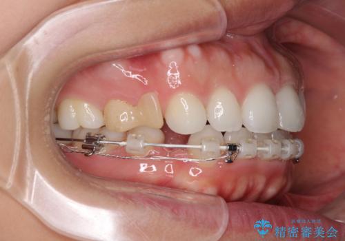 目立たない装置で横顔のシルエットを改善 ハーフリンガルでの抜歯矯正の治療中