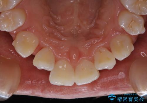 20代女性 インビザラインでのマウスピース矯正中にPMTCできれいな口元にの治療後