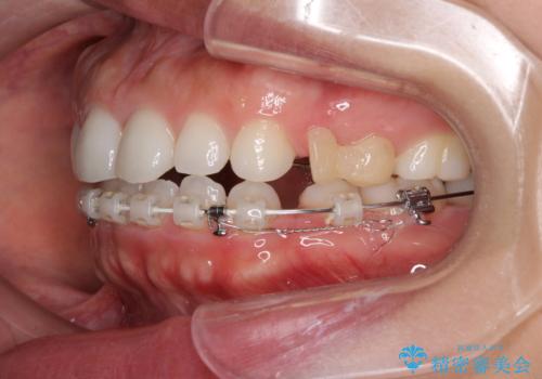 目立たない装置で横顔のシルエットを改善 ハーフリンガルでの抜歯矯正の治療中