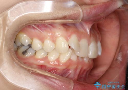 上の前歯が1本前に飛び出している　インビザラインによる目立たない矯正の治療前