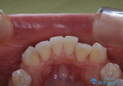 20代女性 インビザラインでのマウスピース矯正中にPMTCできれいな口元にの治療後