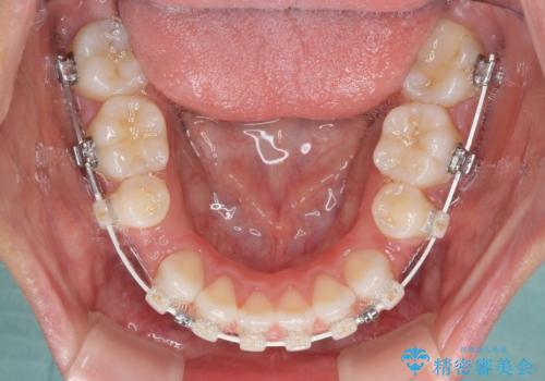 目立たない装置で横顔のシルエットを改善 ハーフリンガルでの抜歯矯正の治療中