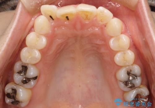 上の前歯が1本前に飛び出している　インビザラインによる目立たない矯正の治療前