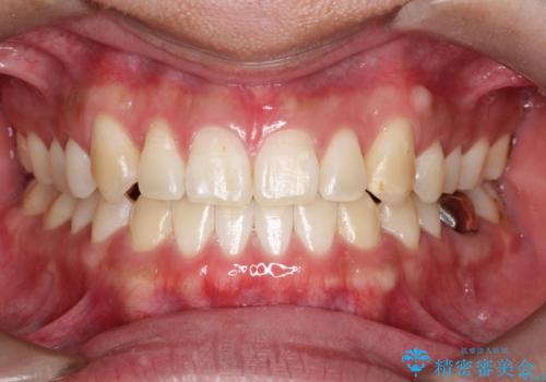 オフィスホワイトニング スタンダードコースの症例 治療前