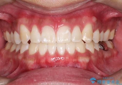 オフィスホワイトニング スタンダードコース