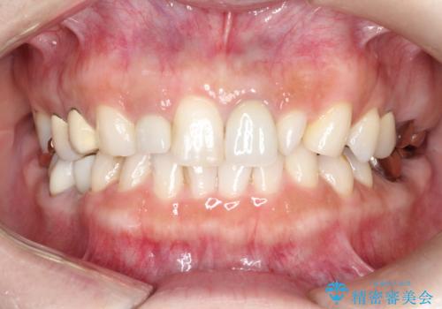 海外での被せ物 色が気になるの症例 治療前