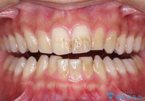 茶渋による着色と下の前歯の裏側のべったり歯石の治療前