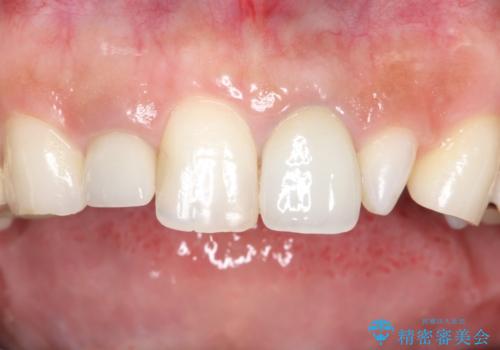海外での被せ物 色が気になるの治療前