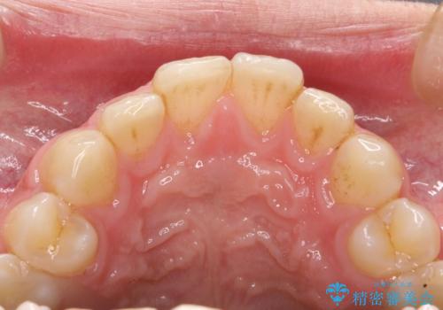 茶渋による着色と下の前歯の裏側のべったり歯石の治療前