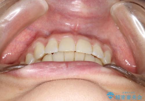 上の前歯が1本前に飛び出している　インビザラインによる目立たない矯正の治療後