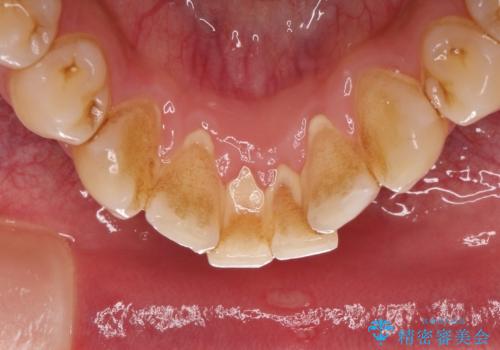 茶渋による着色と下の前歯の裏側のべったり歯石の治療前