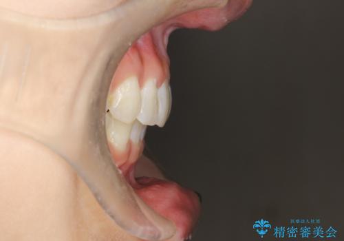 上の前歯が1本前に飛び出している　インビザラインによる目立たない矯正の治療後