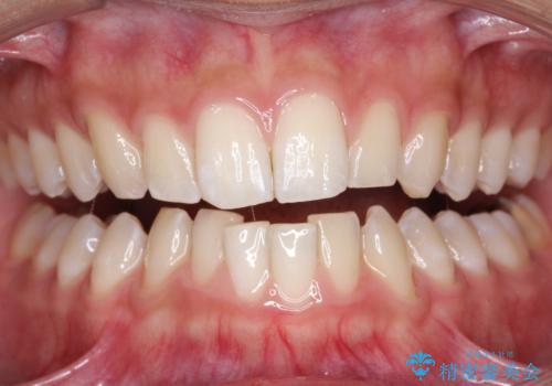茶渋による着色と下の前歯の裏側のべったり歯石の治療後