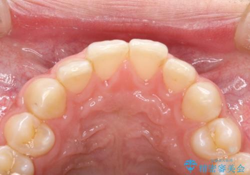 茶渋による着色と下の前歯の裏側のべったり歯石の治療後