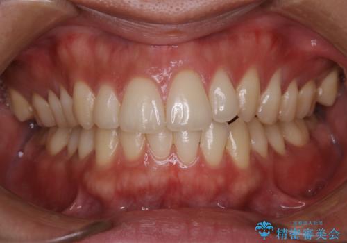 オフィスホワイトニング スペシャルコース3回の治療中
