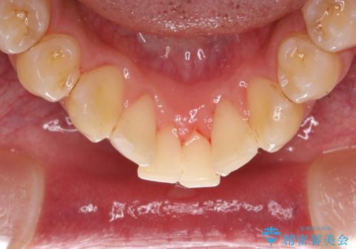 茶渋による着色と下の前歯の裏側のべったり歯石の治療後