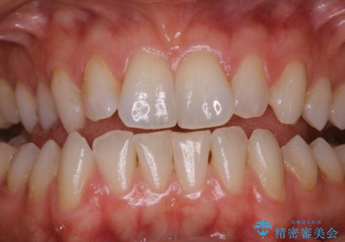 オフィスホワイトニングエクセレントコースの治療前