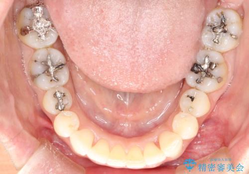 上の前歯が1本前に飛び出している インビザラインによる目立たない矯正の治療後