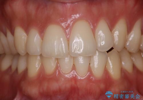 オフィスホワイトニング スペシャルコース3回の治療中