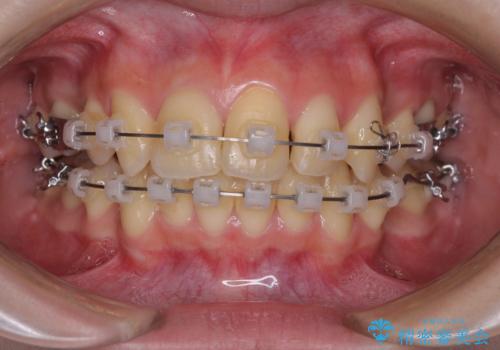 出っ歯を治したい ワイヤー装置による抜歯矯正の治療中