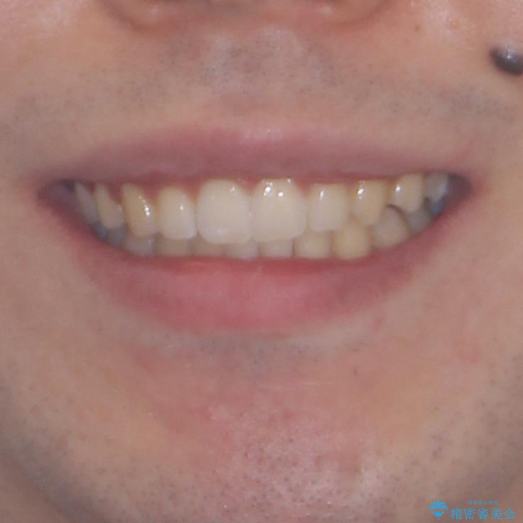 前歯のデコボコと突出感 インビザラインにて矯正治療の治療後(顔貌)