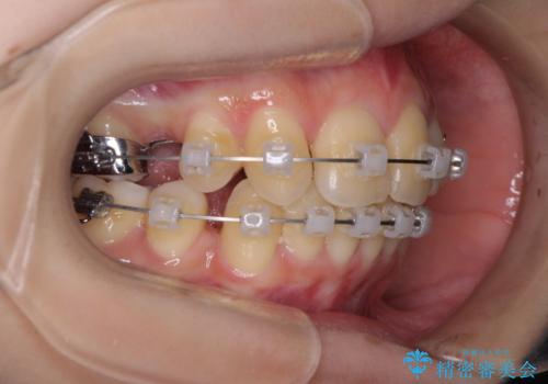 出っ歯を治したい　ワイヤー装置による抜歯矯正の治療中