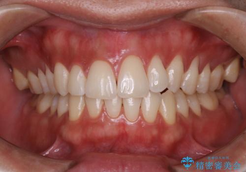 オフィスホワイトニング スペシャルコース3回の症例 治療後