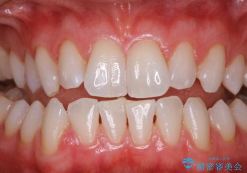 オフィスホワイトニングエクセレントコースの治療後