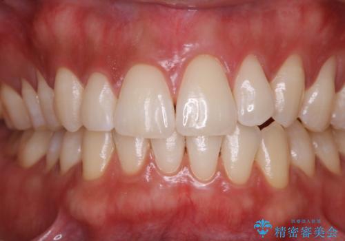 オフィスホワイトニング スペシャルコース3回の治療後