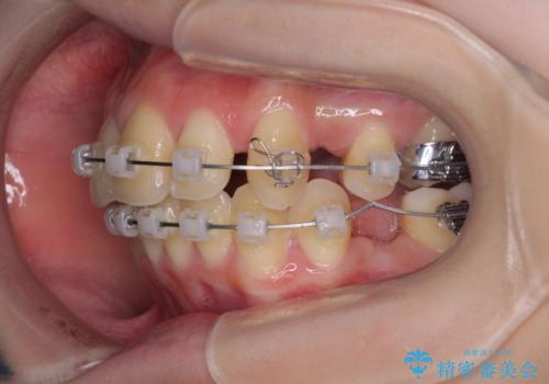 出っ歯を治したい ワイヤー装置による抜歯矯正の治療中