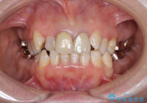 奥歯の銀歯と歯並びを改善　歯周外科治療と矯正治療を行った総合歯科診療の症例 治療前
