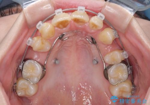 出っ歯を治したい ワイヤー装置による抜歯矯正の治療中