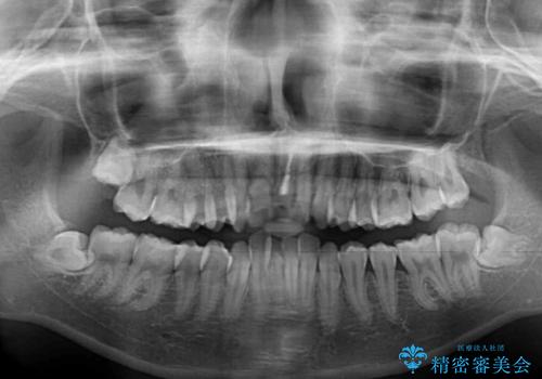 出っ歯を治したい ワイヤー装置による抜歯矯正の治療前