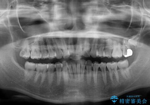 飛び出した前歯と黄ばんだ歯 ホワイトニングしながらマウスピース矯正の治療前