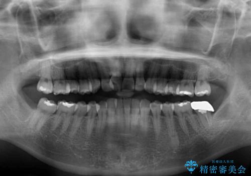 前歯のデコボコをインビザラインでスッキリと仕上げるの治療前