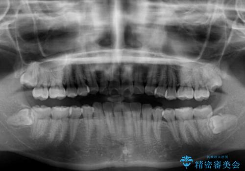 インビザラインを断念 ワイヤー装置で楽々と矯正治療の治療前