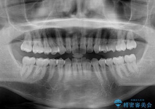 前歯のデコボコと突出感 インビザラインにて矯正治療の治療前