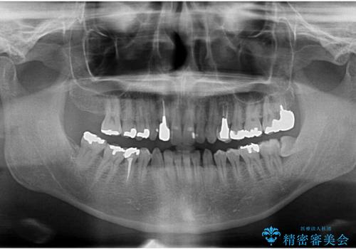 銀歯だらけの口の中を改善したいの治療前