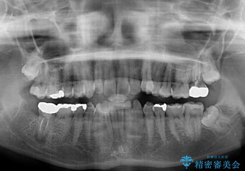 入国制限で帰国できず 海外出張中のインビザライン矯正の治療前