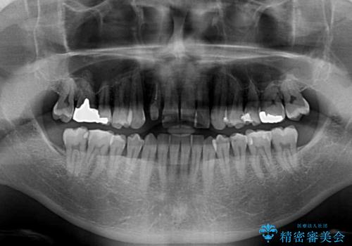 治療途中の前歯を治したい インビザライン矯正とオールセラミッククラウンの治療前