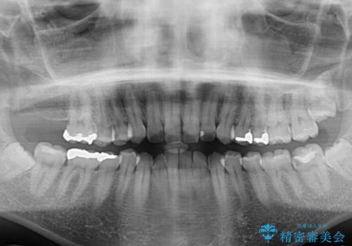 【モニター】前歯のデコボコをインビザラインできれいに整えるの治療前