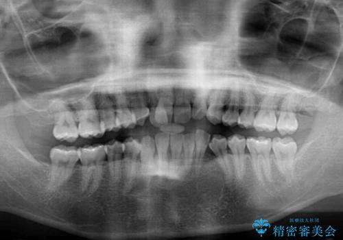 変則的な抜歯矯正　八重歯を抜いてしまった人のワイヤー矯正の治療前