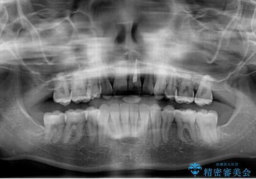 出っ歯を治したい ワイヤー装置による抜歯矯正の治療後