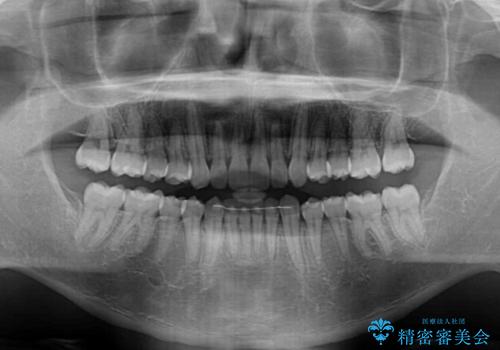 前歯のデコボコと突出感 インビザラインにて矯正治療の治療後